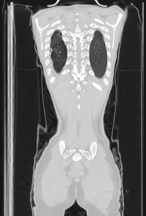 Bronchial carcinoid tumor (Radiopaedia 57187-64090 Coronal lung window 100).jpg