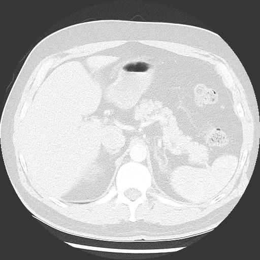 Bronchial carcinoid tumor (Radiopaedia 67377-76764 Axial lung window 62).jpg