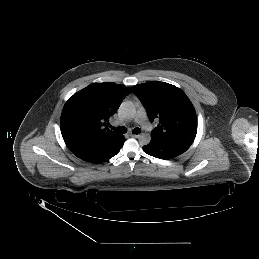 File:Bronchial carcinoid tumor (Radiopaedia 78272-90870 Axial non-contrast 40).jpg
