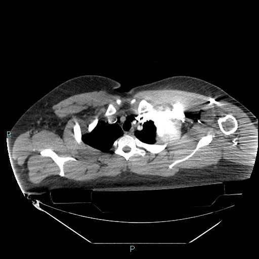 Bronchial carcinoid tumor (Radiopaedia 78272-90870 B 24).jpg