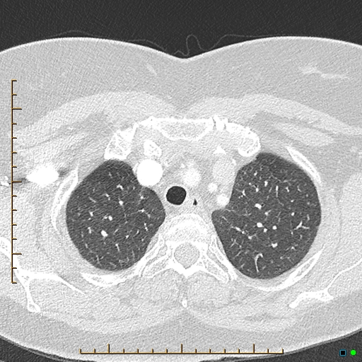 Bronchial diverticula (Radiopaedia 79512-92676 Axial lung window 24).jpg