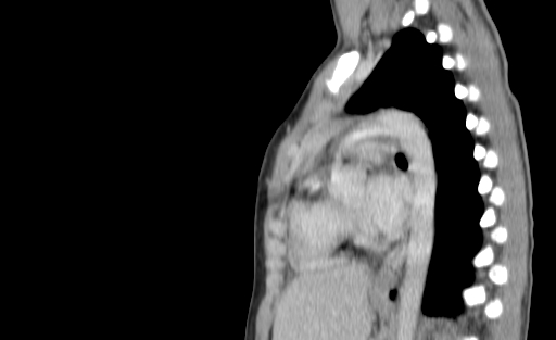 Bronchial mucoepidermoid carcinoma (Radiopaedia 57023-63895 Sagittal 143).jpg