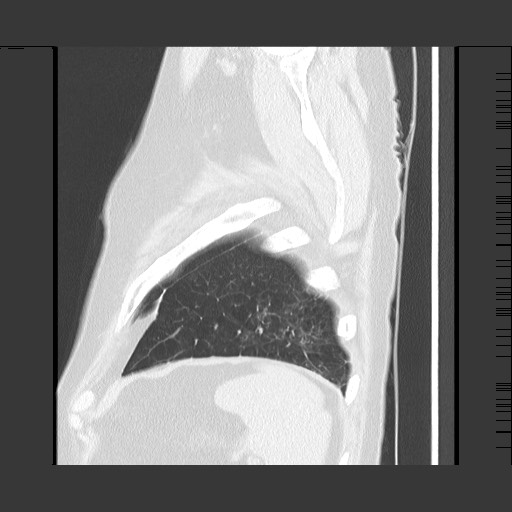 Bronchial stenosis - lung transplant (Radiopaedia 73133-83848 Sagittal lung window 62).jpg