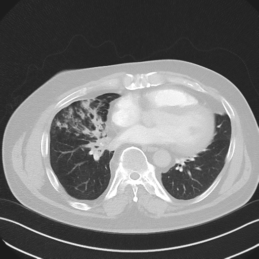 Bronchiectasis (Radiopaedia 39385-41666 Axial lung window 40).png