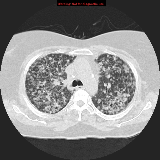 Bronchoalveolar carcinoma (Radiopaedia 13224-13233 Axial lung window 16).jpg