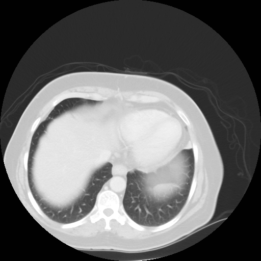 Bronchogenic carcinoma (Radiopaedia 73497-84262 Axial lung window 49).jpg