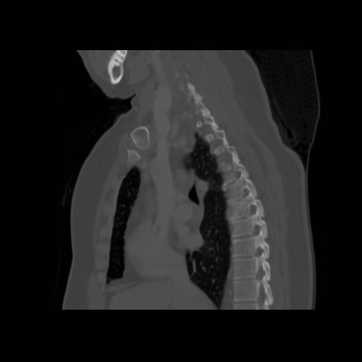 Bronchogenic carcinoma (Radiopaedia 73497-84262 Sagittal bone window 74).jpg