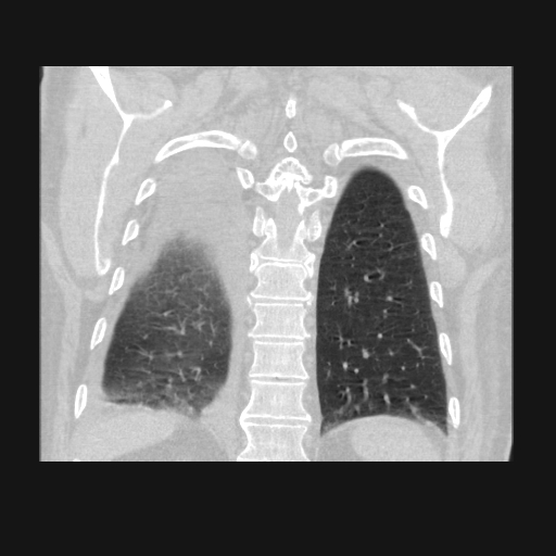 File:Bronchogenic carcinoma with metastatic lymphadenopathy (Radiopaedia 37671-39569 Coronal lung window 38).jpg