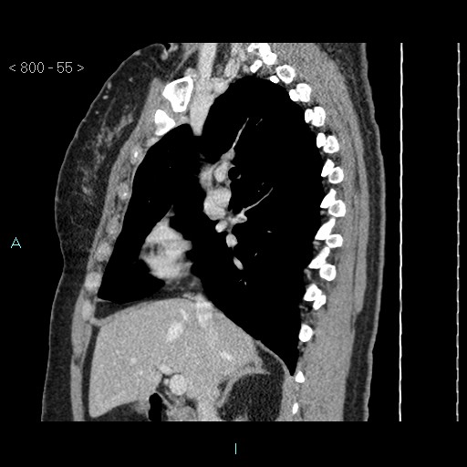 File:Bronchogenic cyst - posterior mediastinal (Radiopaedia 43885-47364 B 36).jpg