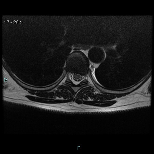 File:Bronchogenic cyst - posterior mediastinal (Radiopaedia 43885-47365 Axial T2 20).jpg