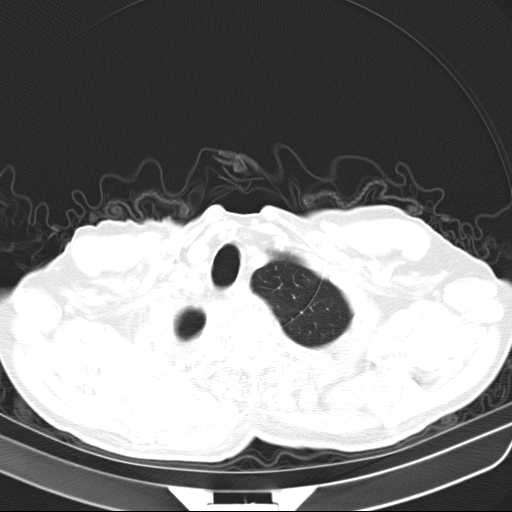Bronchopleural fistula - postoperative complication (Radiopaedia 21020-20947 Axial lung window 5).jpg