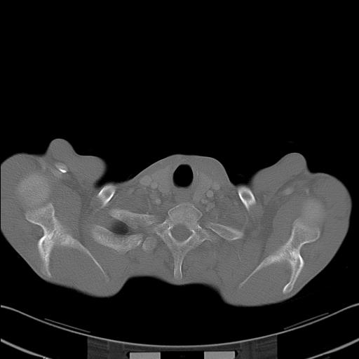 File:Bronchopleural fistula secondary to tuberculosis (Radiopaedia 20415-20322 Axial bone window 3).jpg