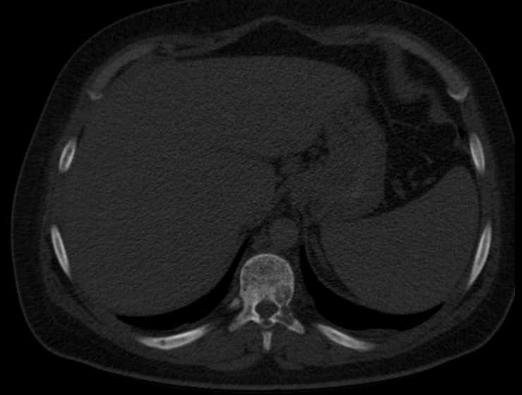 Brown tumors compressing the spinal cord (Radiopaedia 68442-77988 Axial bone window 67).jpg