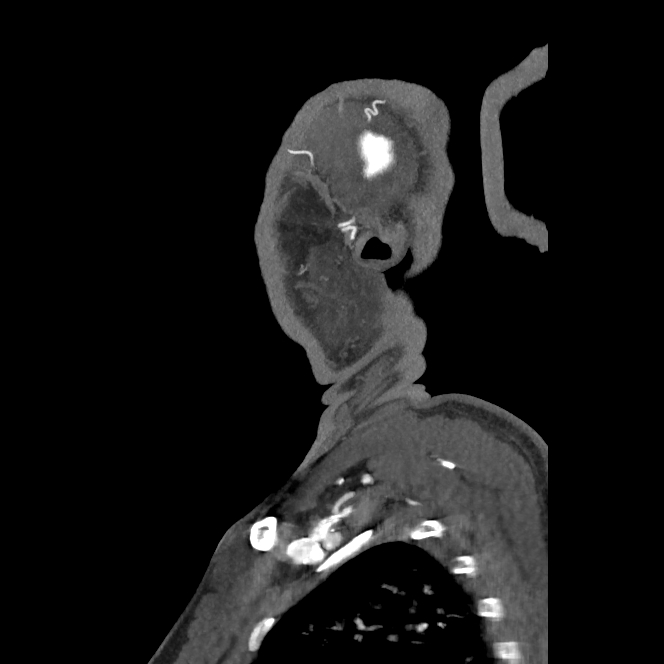 Buccal fat pad arteriovenous malformation (Radiopaedia 70936-81144 C 70).jpg