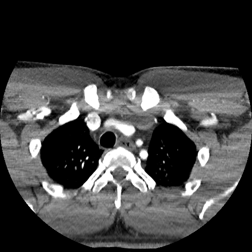 Buccal fat pad arteriovenous malformation (Radiopaedia 70936-81144 D 15).jpg