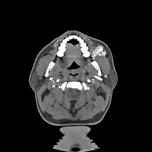 Buccal fat pad arteriovenous malformation (Radiopaedia 70936-81144 D 197).jpg