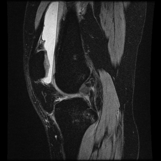 File:Bucket handle meniscus tear (Radiopaedia 56916-63751 H 48).jpg