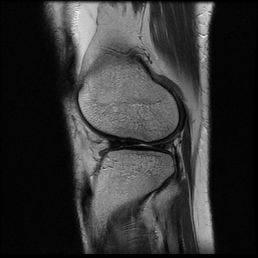 File:Bucket handle meniscus tear (Radiopaedia 56916-63751 Sagittal T2 5).jpg