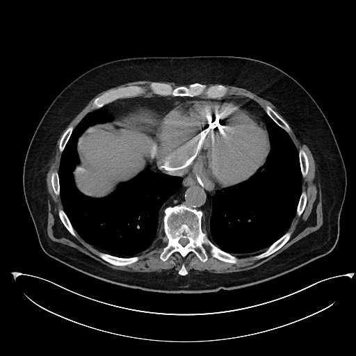 File:Buried bumper syndrome - gastrostomy tube (Radiopaedia 63843-72577 Axial Inject 5).jpg