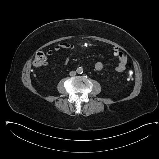 Buried bumper syndrome - gastrostomy tube (Radiopaedia 63843-72577 Axial Inject 65).jpg