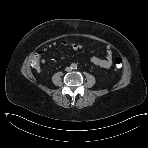 File:Buried bumper syndrome - gastrostomy tube (Radiopaedia 63843-72577 Axial Inject 72).jpg