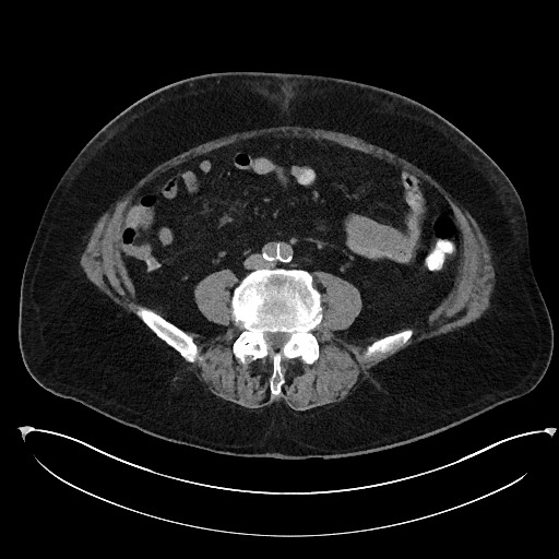 File:Buried bumper syndrome - gastrostomy tube (Radiopaedia 63843-72577 Axial Inject 74).jpg