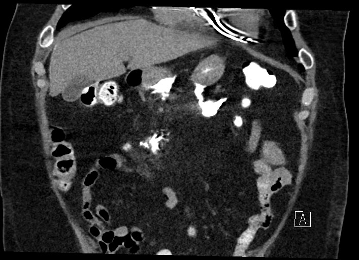Buried bumper syndrome - gastrostomy tube (Radiopaedia 63843-72577 Coronal Inject 42).jpg