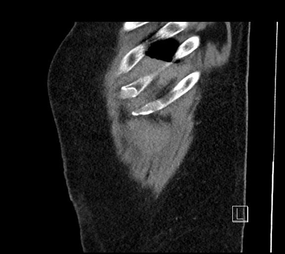 Buried bumper syndrome - gastrostomy tube (Radiopaedia 63843-72577 Sagittal Inject 114).jpg