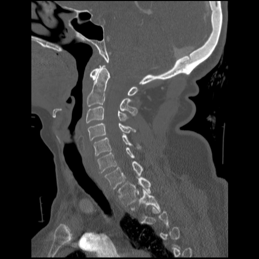 File:C1 anterior arch (plough) fracture - type 1 (Radiopaedia 76181-87720 Sagittal bone window 61).jpg
