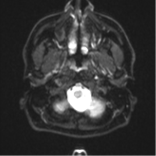File:CNS vasculitis (Radiopaedia 55715-62263 Axial DWI 2).png