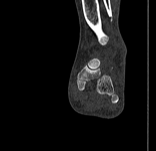 Calcaneal fracture - Sanders type 4 (Radiopaedia 90179-107370 Coronal bone window 54).jpg