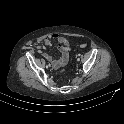 Calcified adrenal glands and Spigelian hernia (Radiopaedia 49741-54988 A 194).jpg