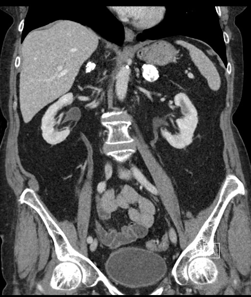 Calcified adrenal glands and Spigelian hernia (Radiopaedia 49741-54988 B 60).jpg