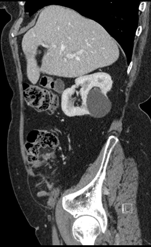 Calcified adrenal glands and Spigelian hernia (Radiopaedia 49741-54988 C 121).jpg