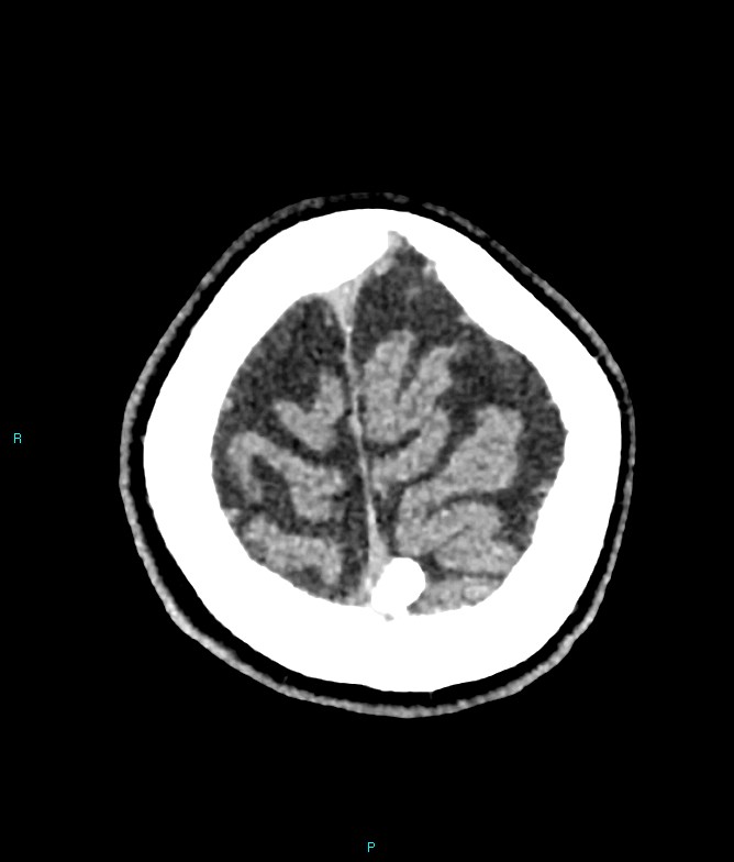 Calcified cerebral emboli from left ventricular thrombus (Radiopaedia 84420-99758 Axial non-contrast 13).jpg