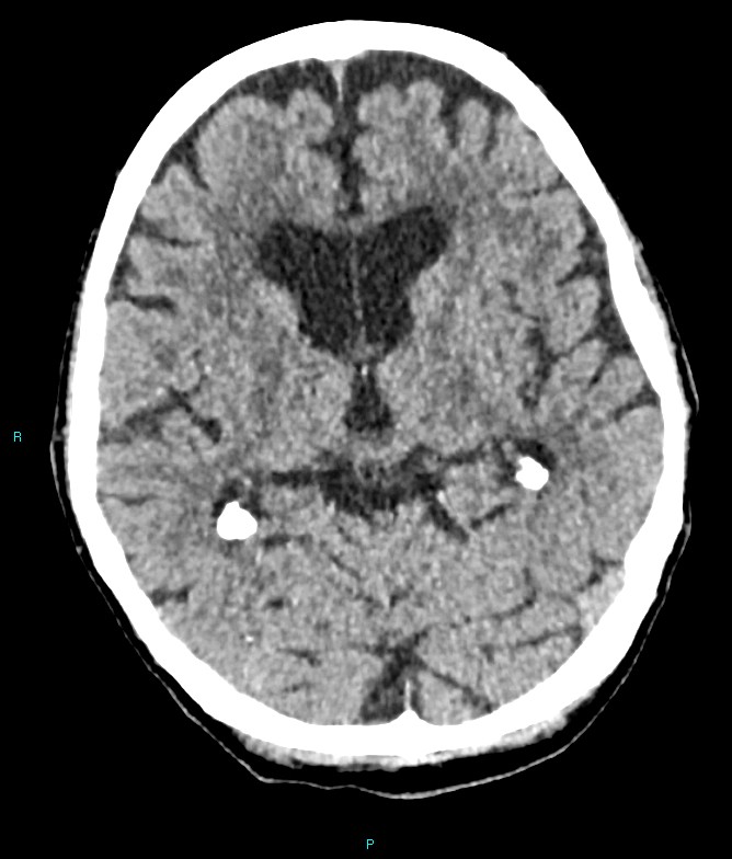 Calcified cerebral emboli from left ventricular thrombus (Radiopaedia 84420-99758 Axial non-contrast 52).jpg