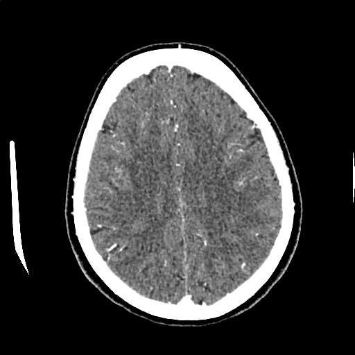 Calcified cerebral hydatid cyst (Radiopaedia 65603-74717 Axial with contrast 56).jpg