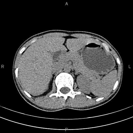 File:Calcified hepatic hydatid cyst (Radiopaedia 83870-99072 Axial non-contrast 51).jpg