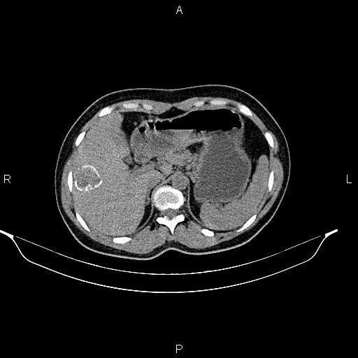 File:Calcified hepatic hydatid cyst (Radiopaedia 84672-100095 Axial non-contrast 27).jpg