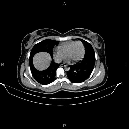 File:Calcified hepatic hydatid cyst (Radiopaedia 84672-100095 Axial non-contrast 7).jpg