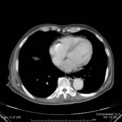 Calcified liver metastases (Radiopaedia 44699-48470 B 2).jpg