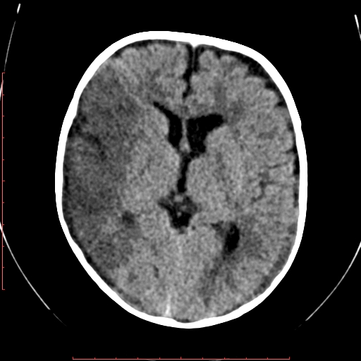 File:Calcified middle cerebral artery embolism (Radiopaedia 78949-91860 Axial non-contrast 13).jpg