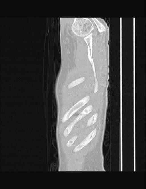 Calcifying pulmonary metastases (Radiopaedia 33359-34396 Sagittal lung window 70).jpg