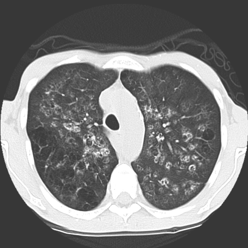 File:Calciphylaxis and metastatic pulmonary calcification (Radiopaedia 10887-11317 Axial lung window 11).jpg