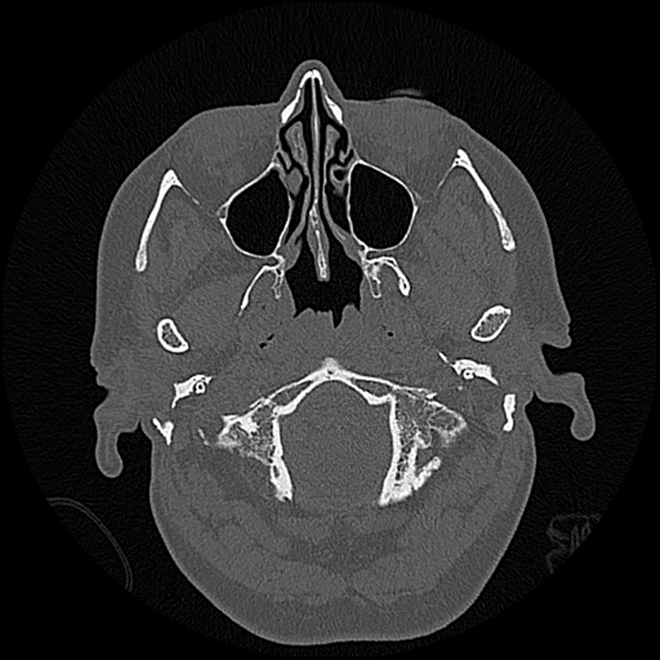 Canal up mastoidectomy (Radiopaedia 78108-90638 Axial bone window 17).jpg