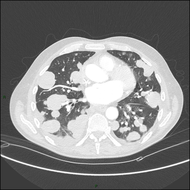 Cannonball metastases (Radiopaedia 82110-96150 Axial lung window 115).jpg