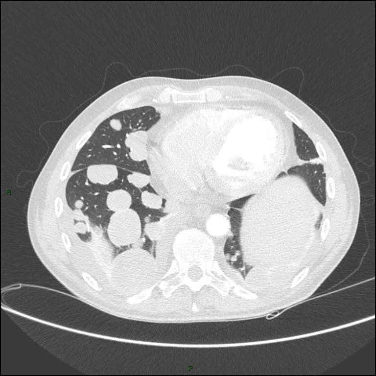 Cannonball metastases (Radiopaedia 82110-96150 Axial lung window 141).jpg