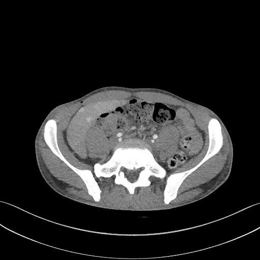 File:Cannonball metastases - testicular choriocarcinoma (Radiopaedia 84510-99891 B 158).jpg