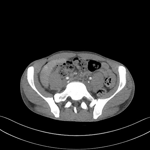 Cannonball metastases - testicular choriocarcinoma (Radiopaedia 84510-99891 B 160).jpg