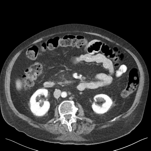 Cannonball metastases from endometrial cancer (Radiopaedia 42003-45031 E 35).png